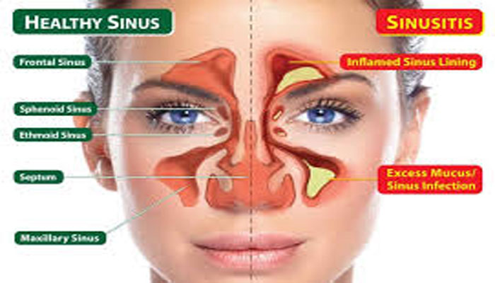 সাইনাসের সমস্যায় জীবন হয়ে উঠতে পারে দুর্বিষহ! বিশদে জানুন কী করণীয়
